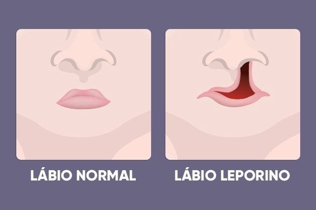 Cleft lip: what it is, causes and treatment