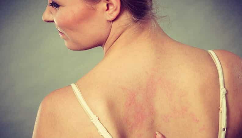 Sensitive skin, what it is, what are the symptoms and treatments