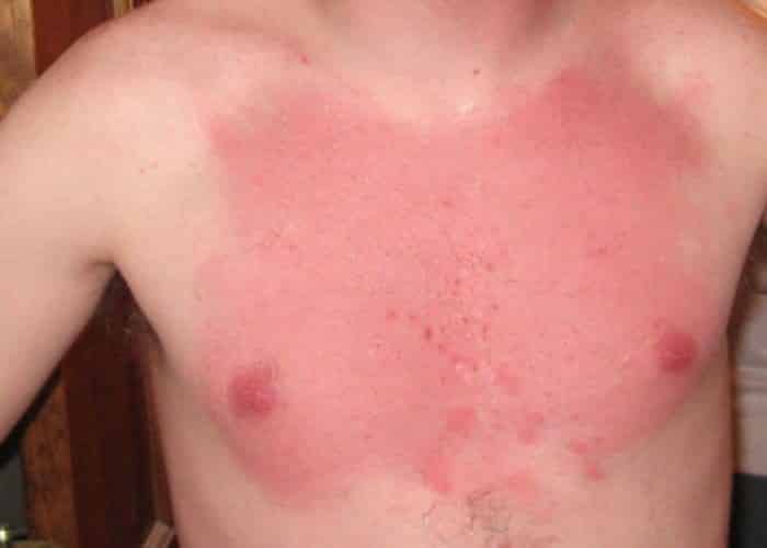 Sensitive skin, what it is, what are the symptoms and treatments