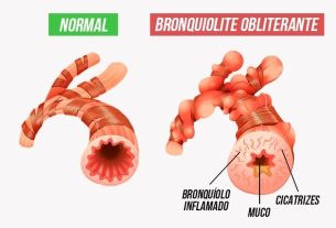 Bronchiolitis obliterans: what it is, symptoms, causes and treatment