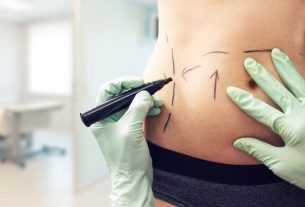 Liposculpture: what it is, when it is indicated, how it is done and recovery