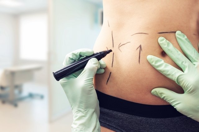 Liposculpture: what it is, when it is indicated, how it is done and recovery