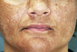 Melasma: what it is, causes, symptoms and diagnosis