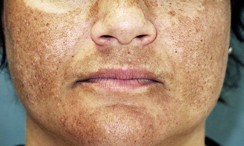 Melasma: what it is, causes, symptoms and diagnosis