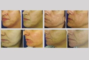 Fractional CO2 laser: what it is for and how it is done