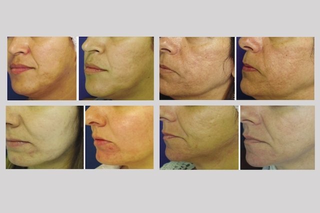 Fractional CO2 laser: what it is for and how it is done