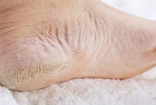 How to treat cracked feet (and main causes)