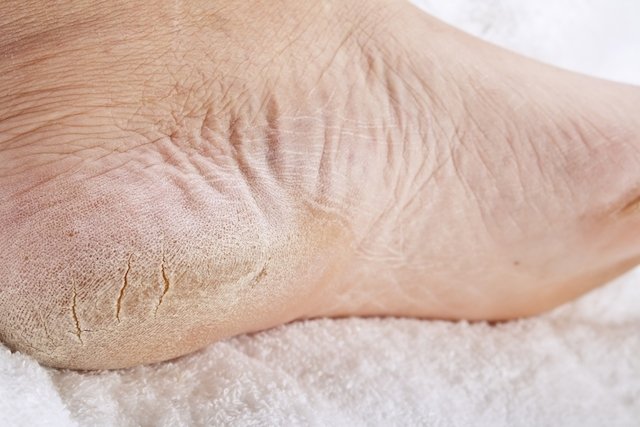 How to treat cracked feet (and main causes)