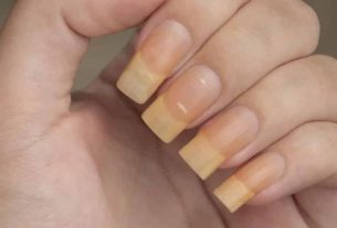 Yellow nails can indicate health problems