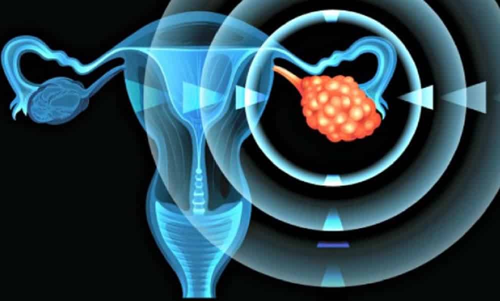 Ciência descobre causa do ovário policístico e cura pode estar a caminho