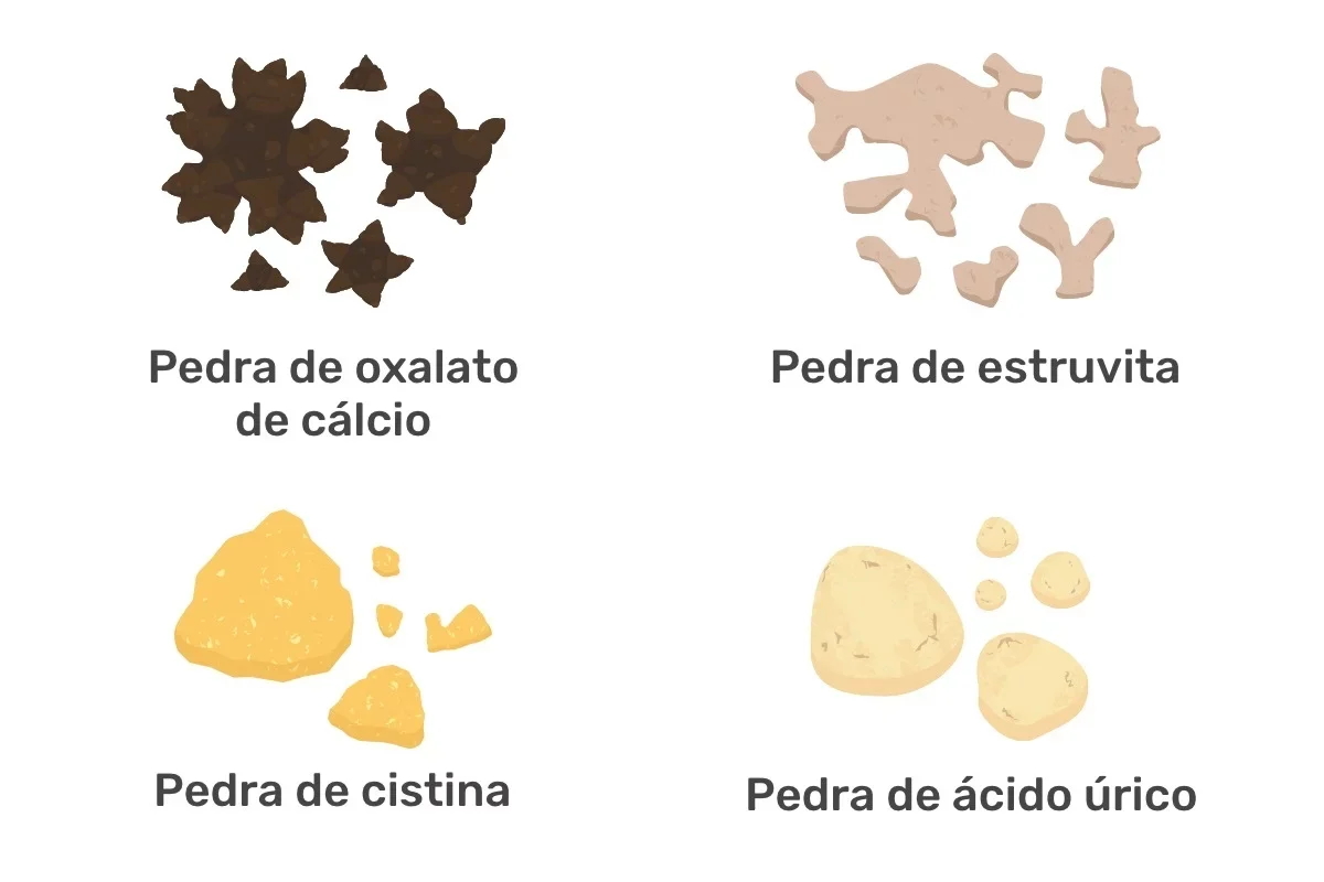 4 tipos de cálculos renales (alimentos y cómo eliminarlos)