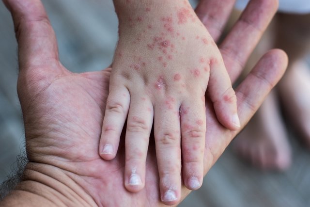 8 main symptoms of rubella