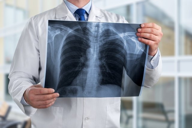 8 main symptoms of tuberculosis (with online test)