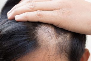 Alopecia areata é uma doença que provoca a queda de cabelo