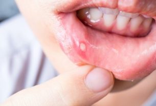 Aphthous stomatitis: what it is, symptoms, causes and treatment