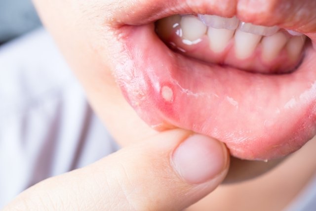 Aphthous stomatitis: what it is, symptoms, causes and treatment