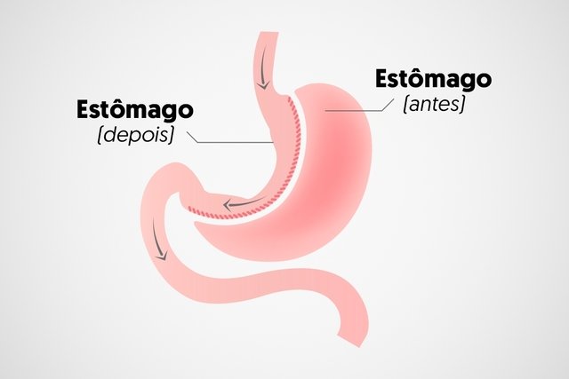 Bariatric sleeve: what it is, advantages, risks and recovery