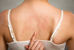 Cholinergic urticaria: what it is, symptoms, causes and treatment