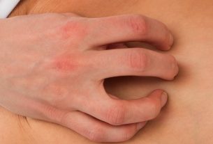 Dermatophytosis: what it is, types, symptoms and treatment