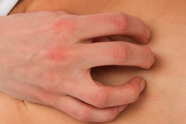 Dermatophytosis: what it is, types, symptoms and treatment