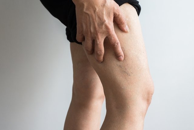 Foam sclerotherapy: what it is and how it is done and possible risks