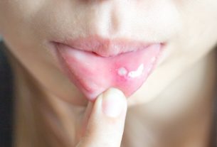 Frequent canker sores: 7 main causes and what to do