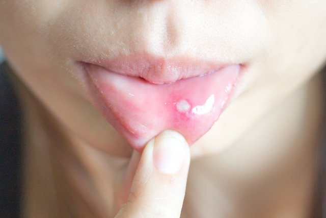 Frequent canker sores: 7 main causes and what to do