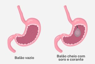 Gastric balloon: what it is, when it is indicated and how it is placed