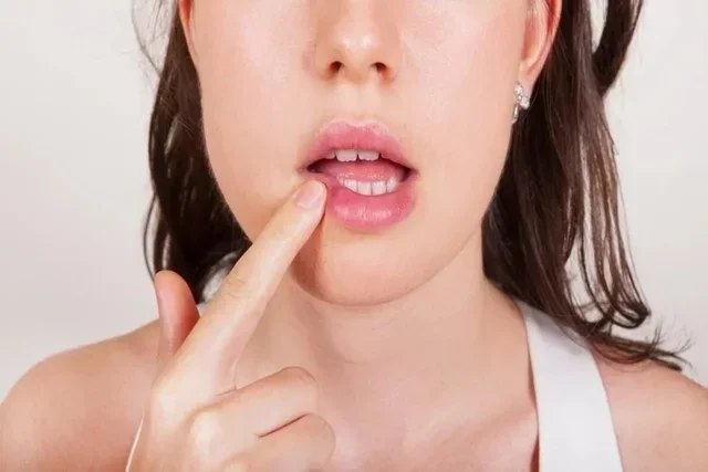 Herpes labial durante el embarazo: síntomas y tratamiento