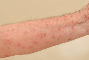 Human scabies: what it is, symptoms, photo and treatment