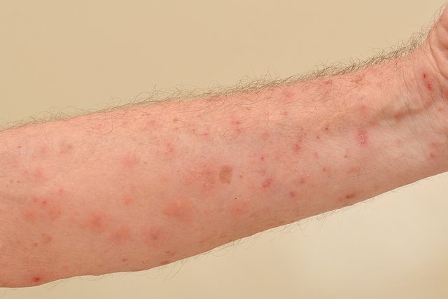 Human scabies: what it is, symptoms, photo and treatment