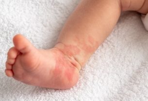 Infantile hemangioma: what it is, symptoms, causes and treatment