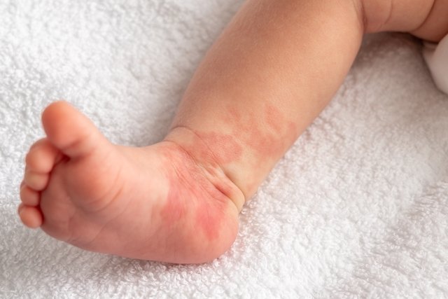 Infantile hemangioma: what it is, symptoms, causes and treatment