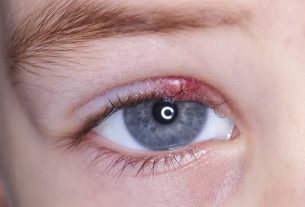 Is stye contagious?  Understand how to catch it (and how to avoid it)