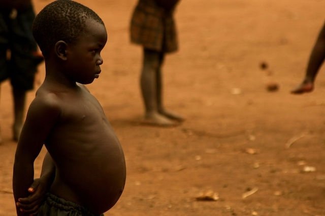 Kwashiorkor: what it is, symptoms, causes and treatment