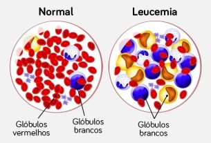 Leukemia: what it is, types, symptoms, causes and treatment