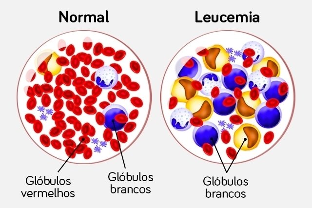 Leukemia: what it is, types, symptoms, causes and treatment