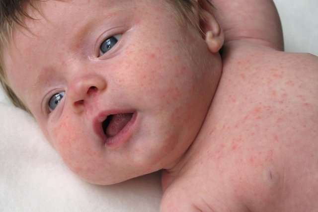 Lump on baby's face: 4 causes and what to do (with photos)