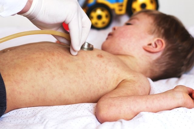 Measles: what it is, symptoms, transmission and treatment