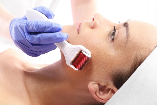 Microneedling: what it is, what it is for and how it is done