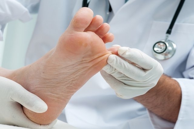 Mycosis on the foot (ringworm): what it is, symptoms and treatment