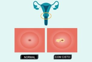 Nabothian cyst: what it is, symptoms, causes and treatment