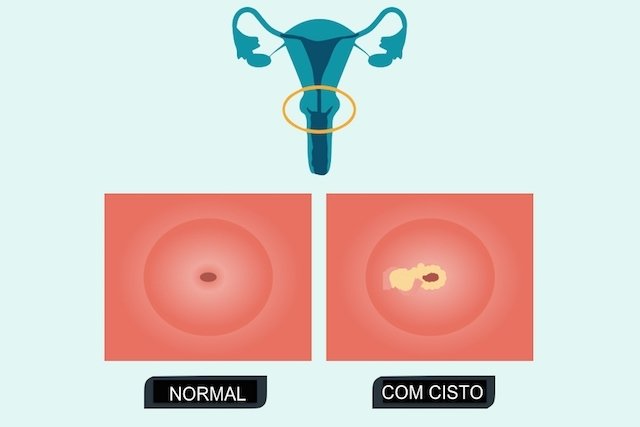 Nabothian cyst: what it is, symptoms, causes and treatment