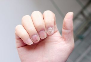 Nail psoriasis (nails): what it is, symptoms and treatment