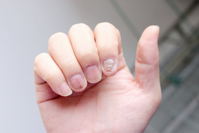 Nail psoriasis (nails): what it is, symptoms and treatment