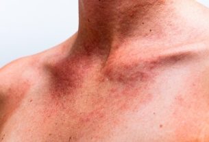 Nervous urticaria: what it is, symptoms, causes and treatment