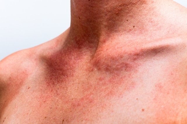 Nervous urticaria: what it is, symptoms, causes and treatment