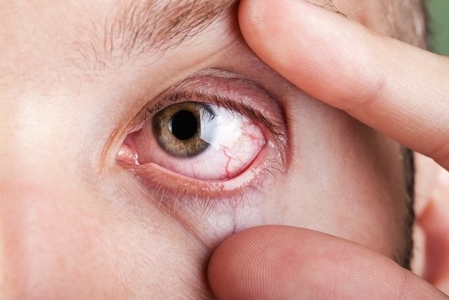 Ocular toxoplasmosis: what it is, symptoms and treatment