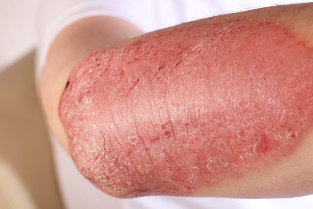 Psoriasis on the elbow