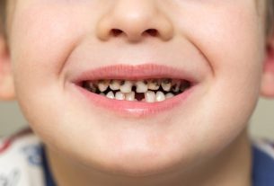 Rotten tooth: 4 main causes (and how to treat)